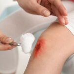 The Role of Infection Control in Wound and Burn Care