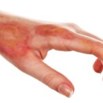 Burn Wound Recovery: Challenges and Best Rehabilitation Methods